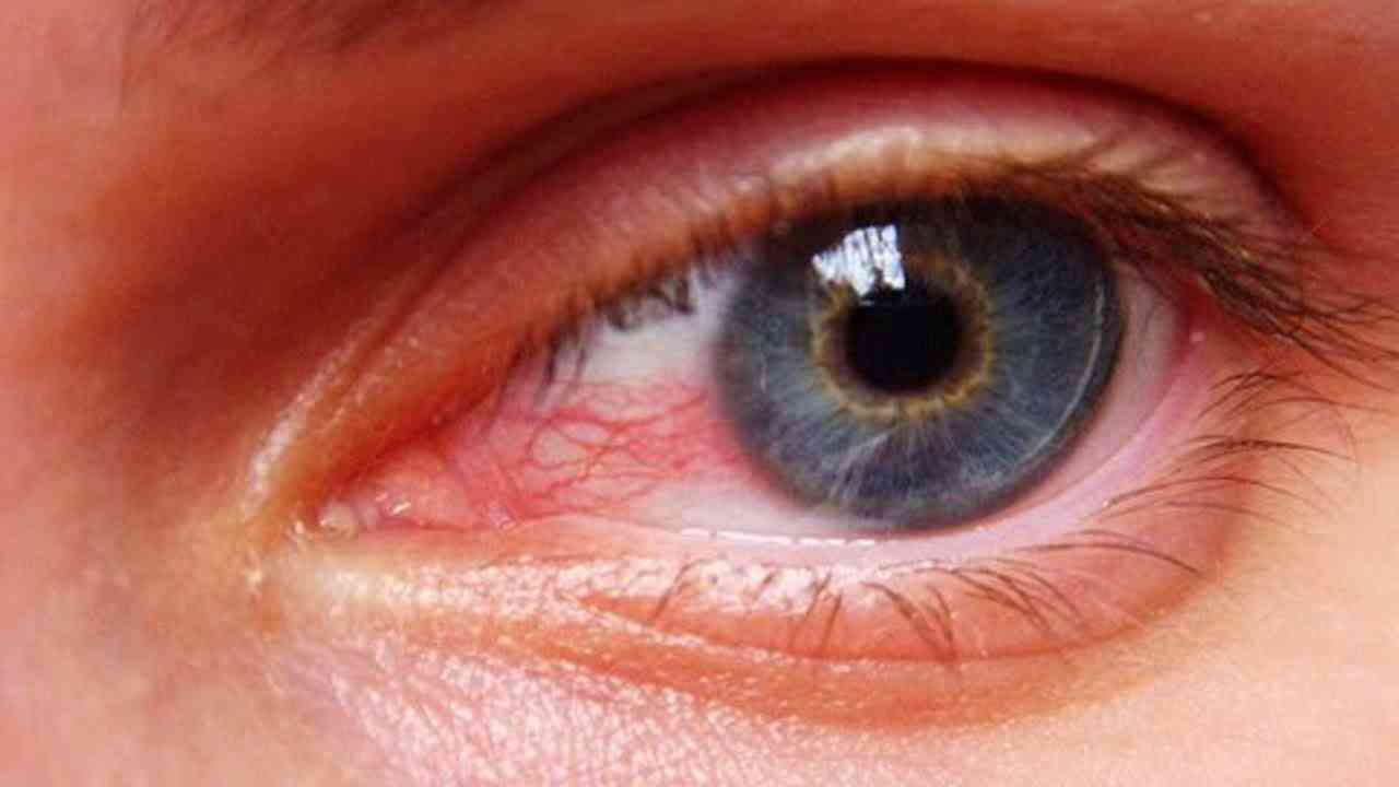 احمرار العين ينذر بأمراض خطيرة