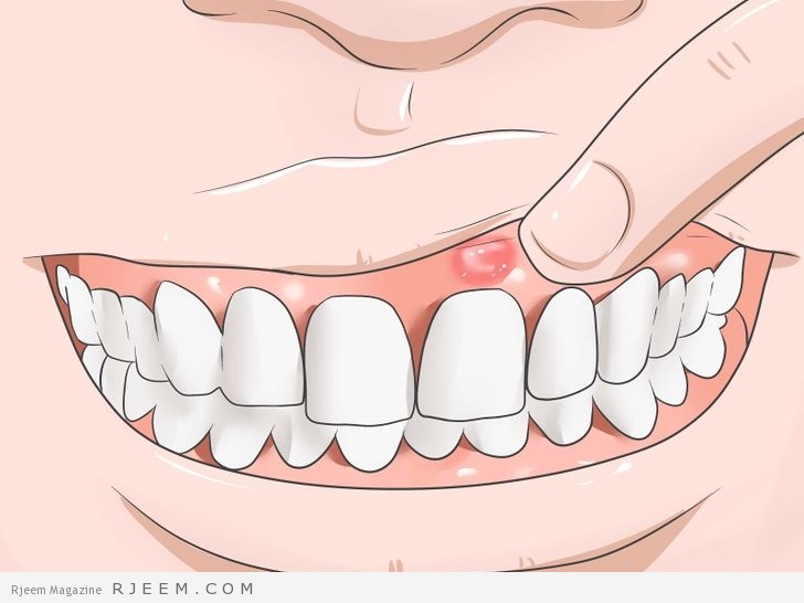 5 علاجات منزلية تقضي على آلام الأسنان