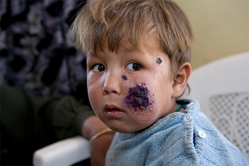 مرض وبائي يهدد سكان الأردن يتسبب بتشوهات في الوجه