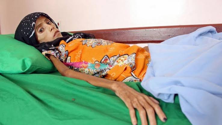 فتاة يمنية تعاني سوء التغذية تعكس كارثية الوضع الإنساني في البلاد (صورة+فيديو) 