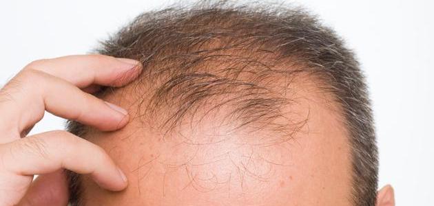 وصفة بسيطة وفعالة لعلاج الصلع وإنبات الشعر من جديد