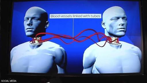 إجراء أول عملية «ناجحة» لزراعة رأس جثة بشرية