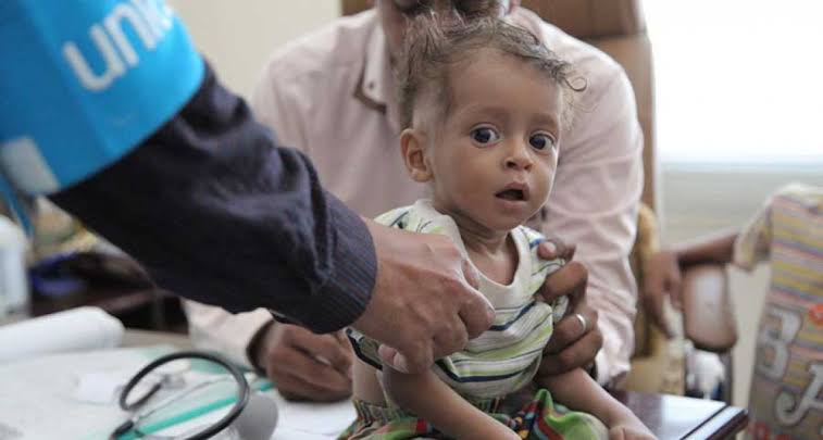 طفل يمني مصاب بسوء التغذية 