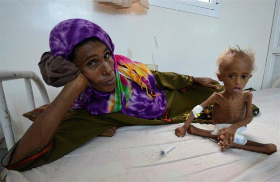 من المسؤول عن المجاعة التي تشهدها محافظة الحديدة غرب اليمن ؟